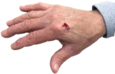 Lacerations